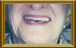 edges of teeth translucent